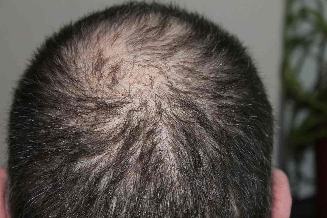 Hair Loss Prevention And Treatment, Home Remedies