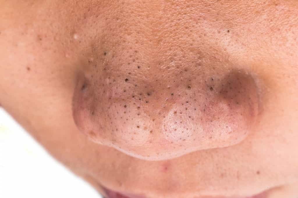 How to Get Rid of Blackheads on Nose Fast And Natural Way