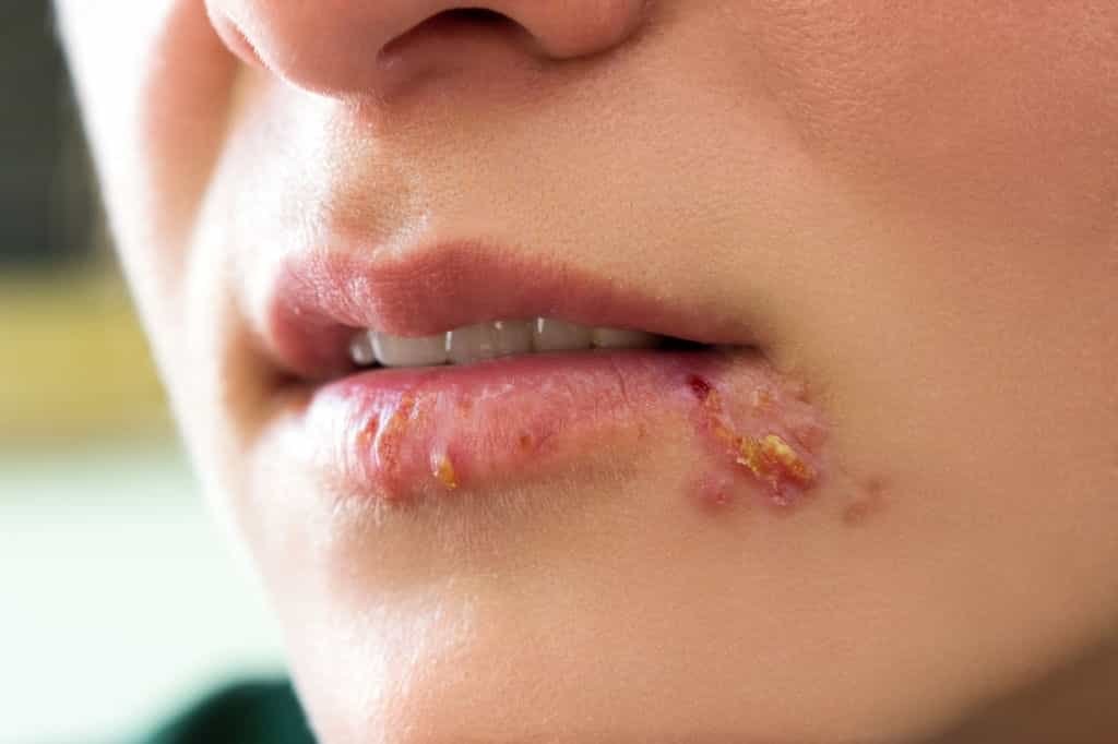 How to get rid of a pimple on lip Cause & Treatments