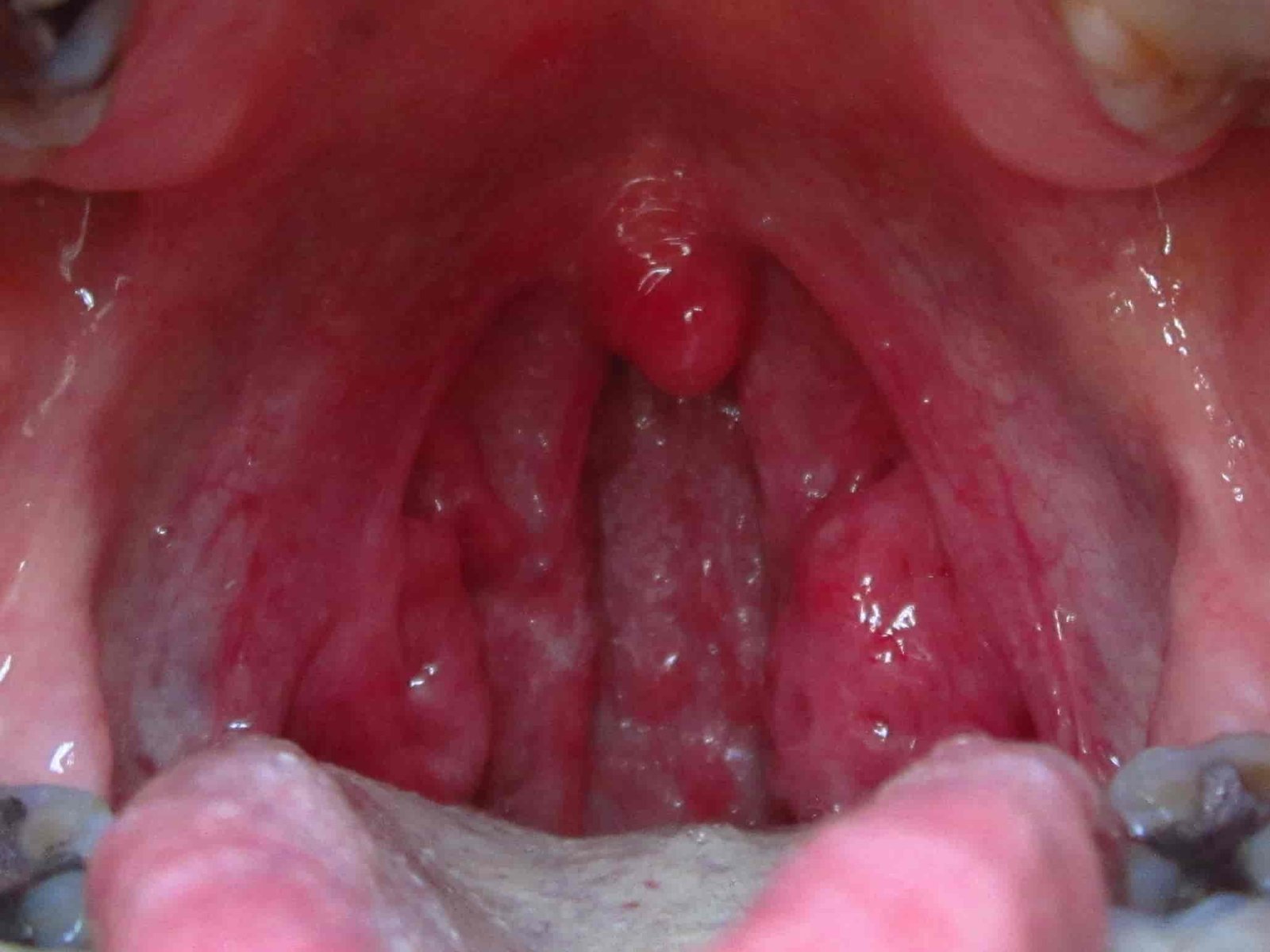 White Spots on Tonsils Symptoms, Causes and Treatments